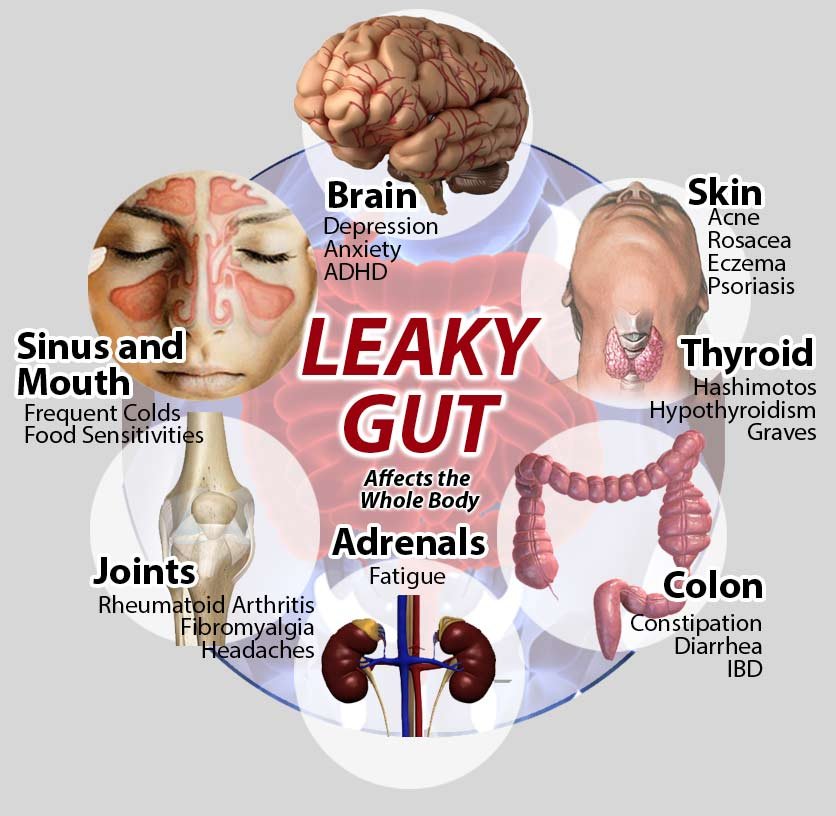 leaky guts